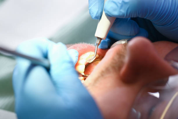 Best Emergency Dentist for Lost Fillings or Crowns in Wilton Manors, FL