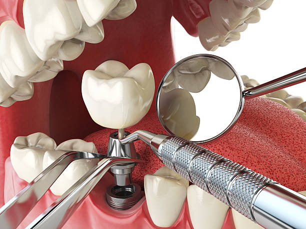 Best Emergency Root Canal Treatment in Wilton Manors, FL